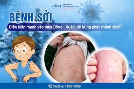 CÁCH PHÒNG TRÁNH BỆNH SỞI
